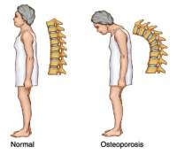   OSTEOPOROSIS Y CALCIO